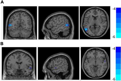 Abnormal Brain Structure Morphology in Early-Onset Schizophrenia